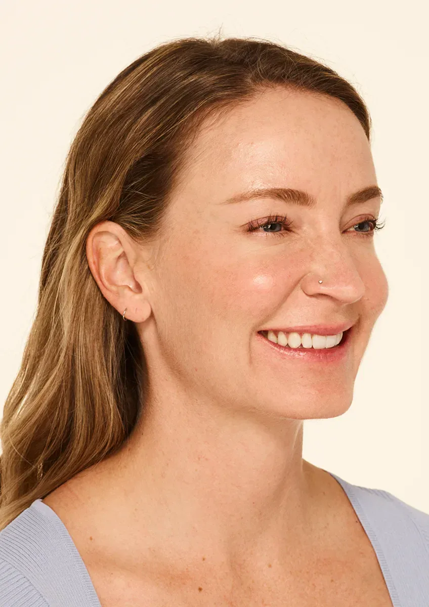 Softened crow's feet thirty days after a wrinkle-relaxer treatment