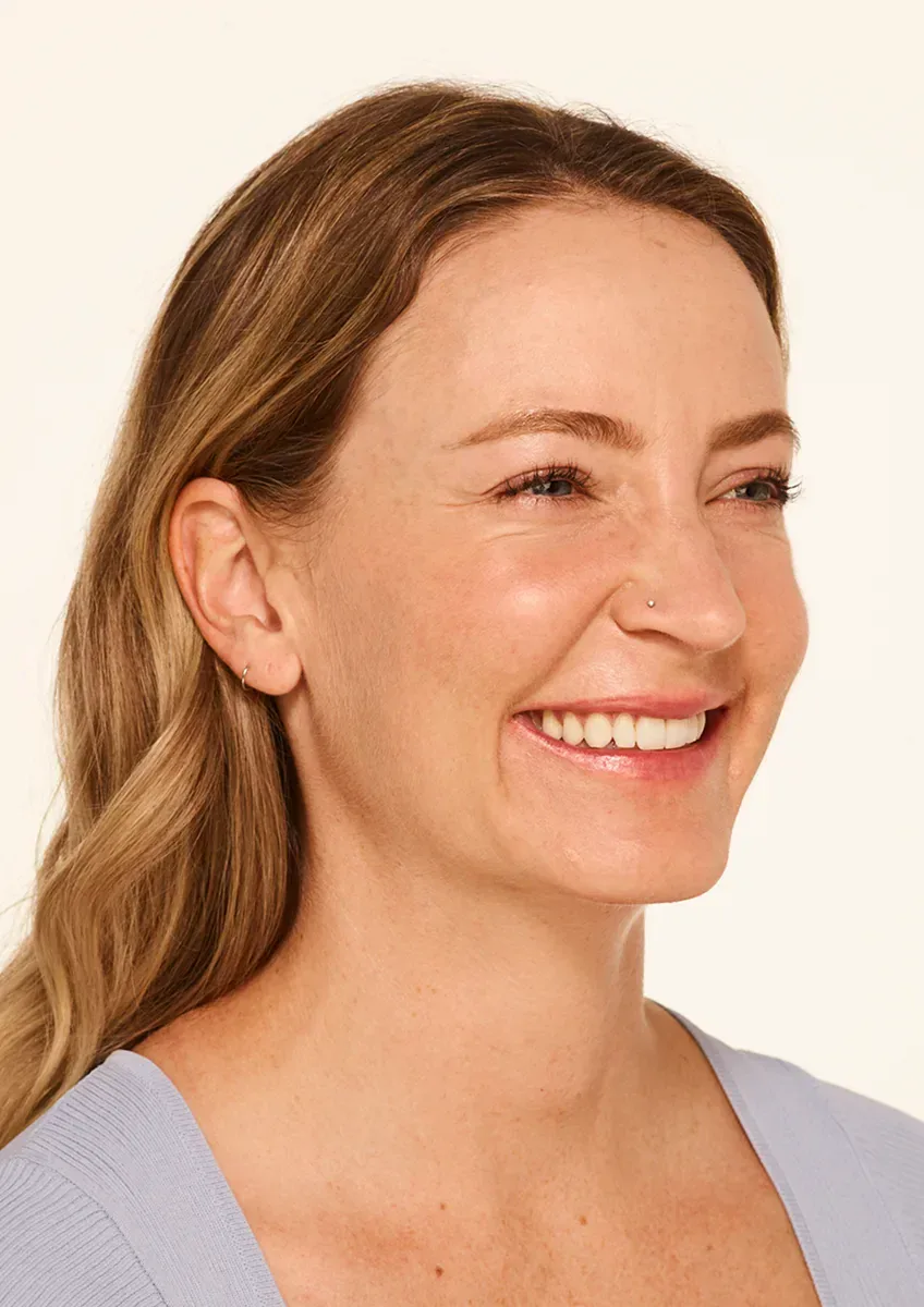 Crow's feet lines at the corner of the eye before a wrinkle-relaxer treatment
