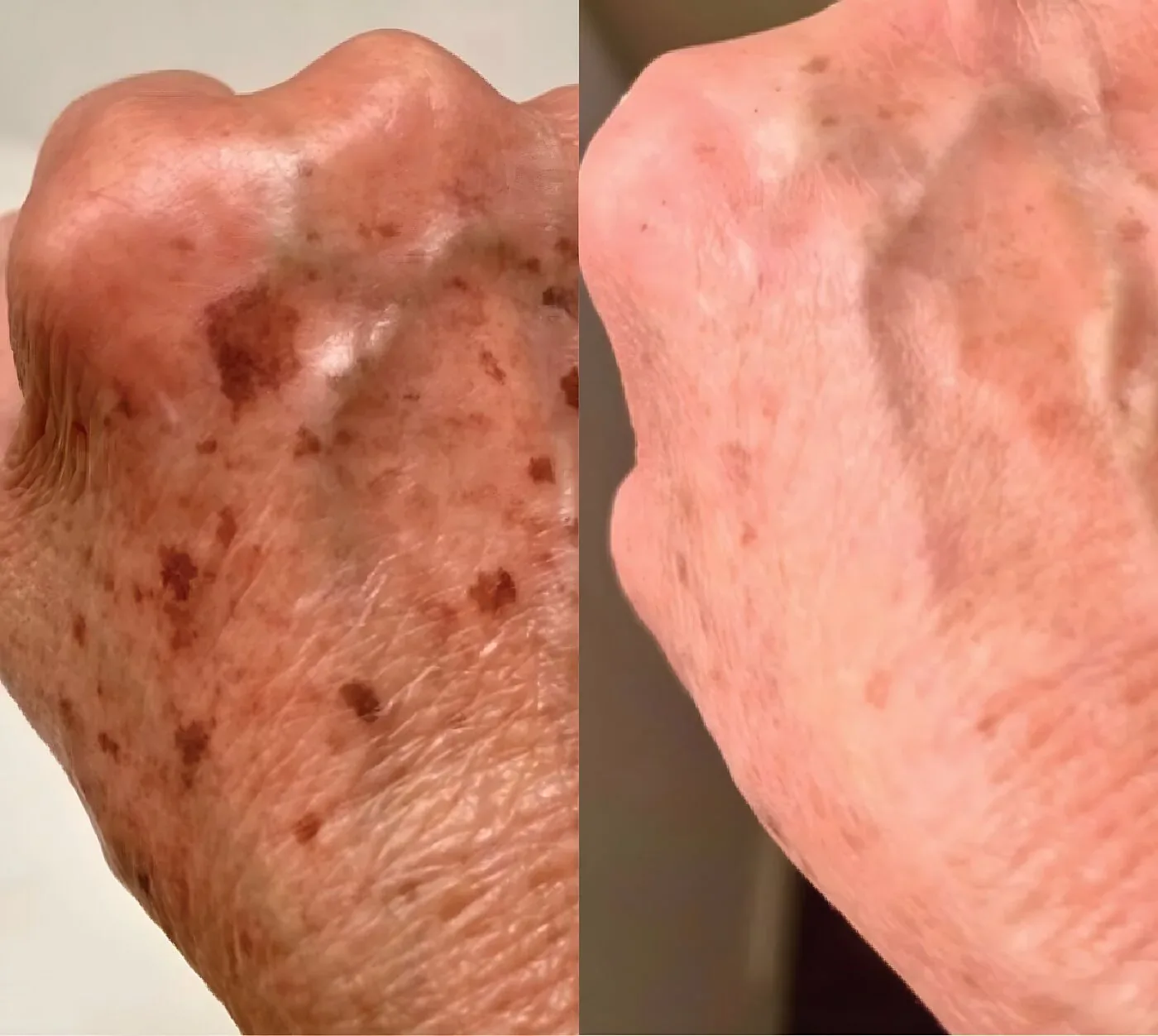 Sun spots on the back of the hand before and faded after a chemical peel