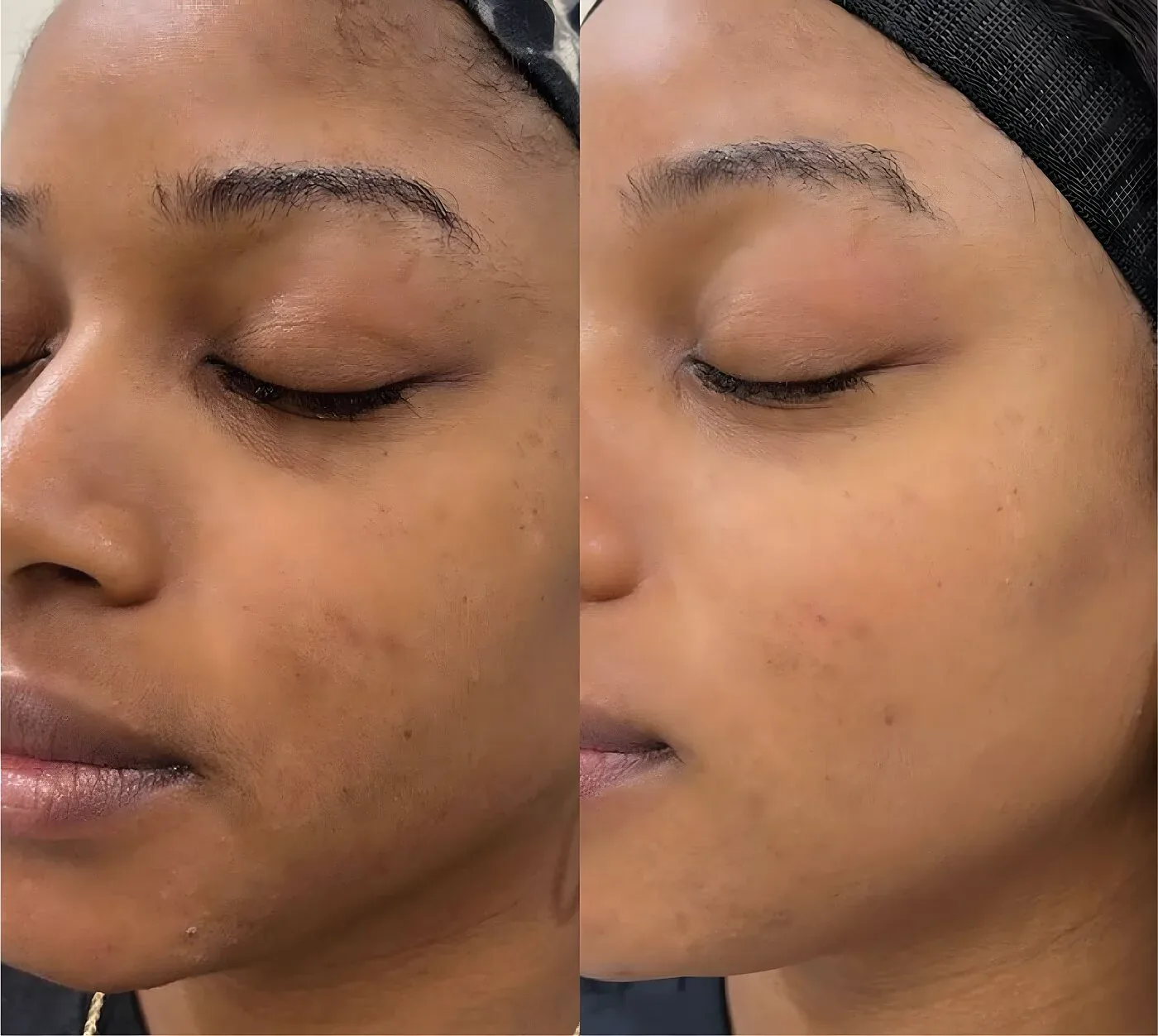 Cheek melasma before and noticeably lighter after a medical-grade chemical peel