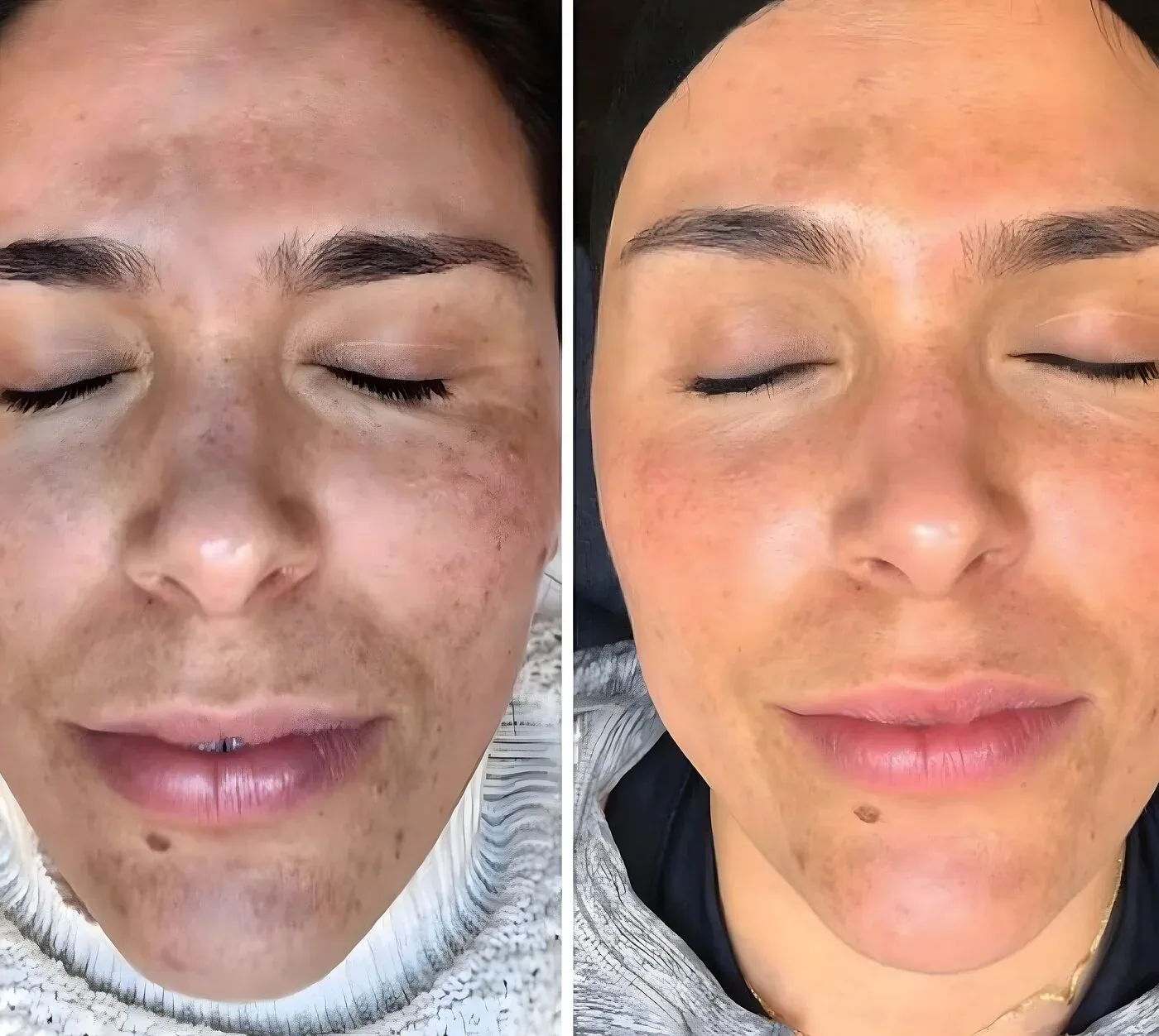 Facial sun damage before and clearer, more even skin after a chemical peel