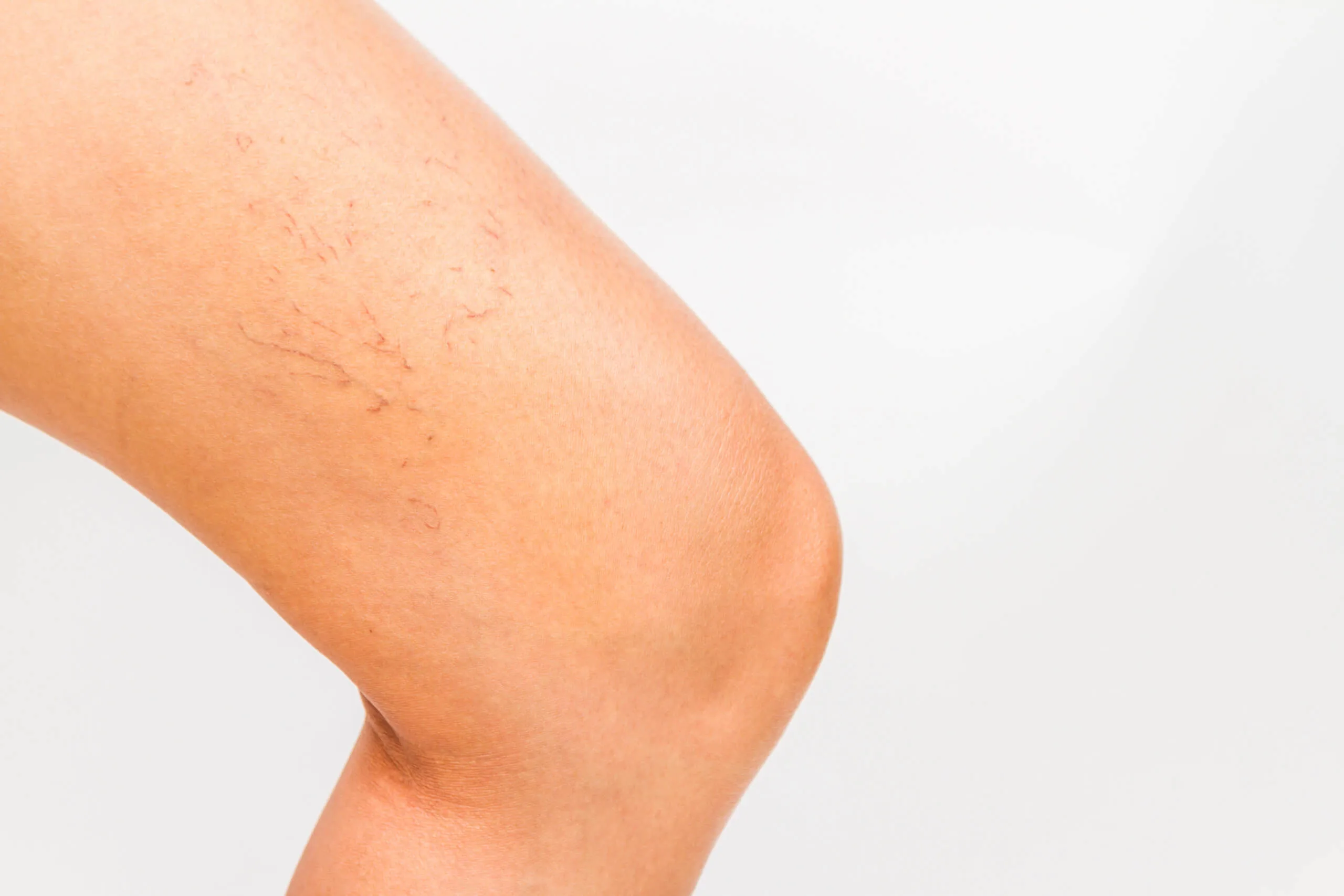 Fine red and purple spider veins branching across the lower leg, the surface vessels sclerotherapy treats