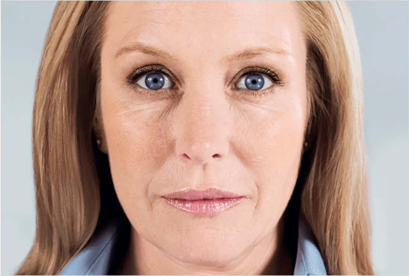 Restored lower-face volume after a series of Sculptra collagen treatments