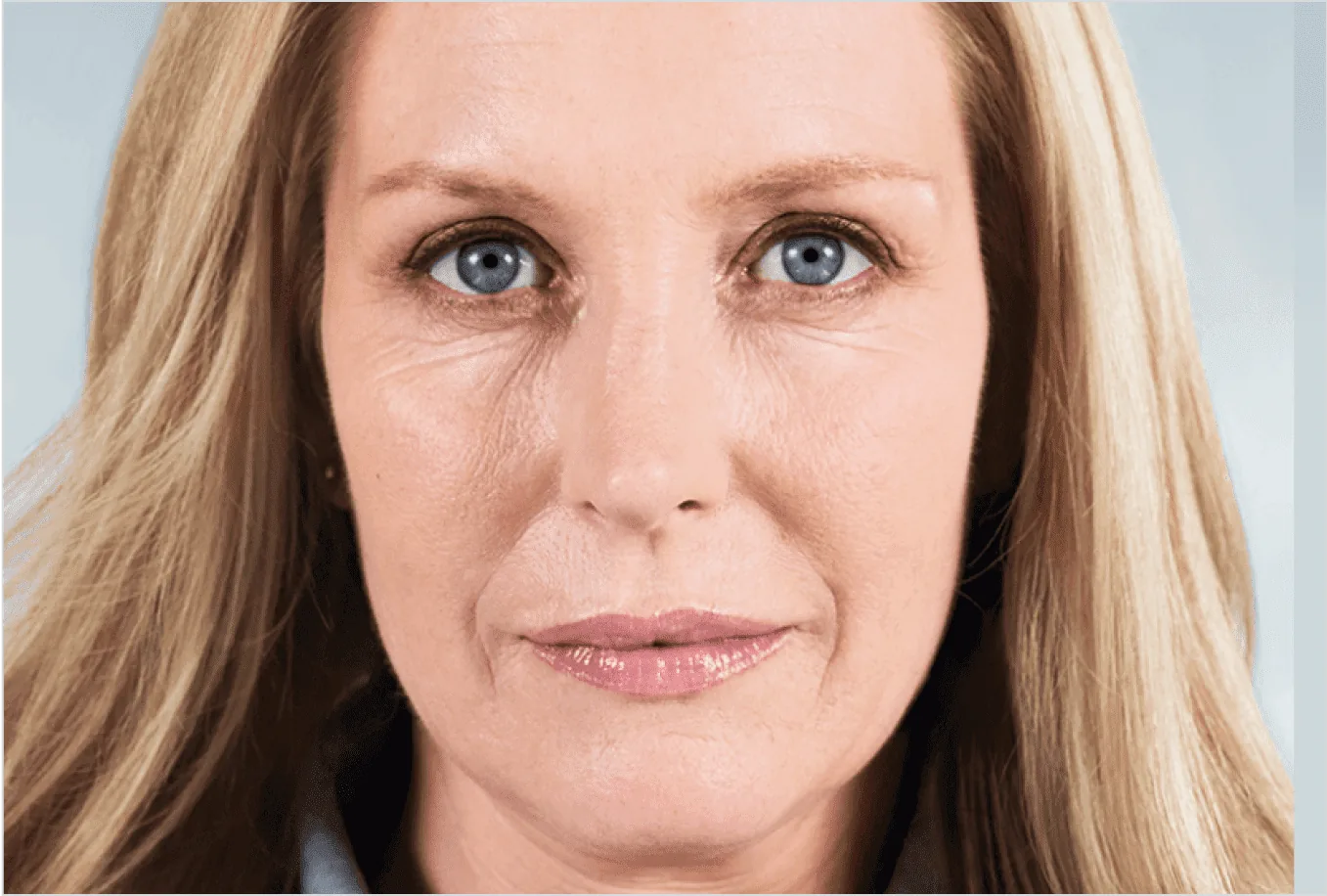 Lower-face volume loss and laxity before Sculptra collagen treatment