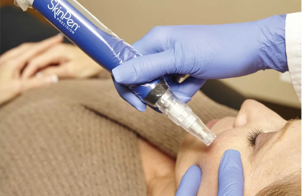 Microneedling treatment in progress, the controlled micro-injury technique used to stimulate the scalp and open micro-channels for regenerative solutions