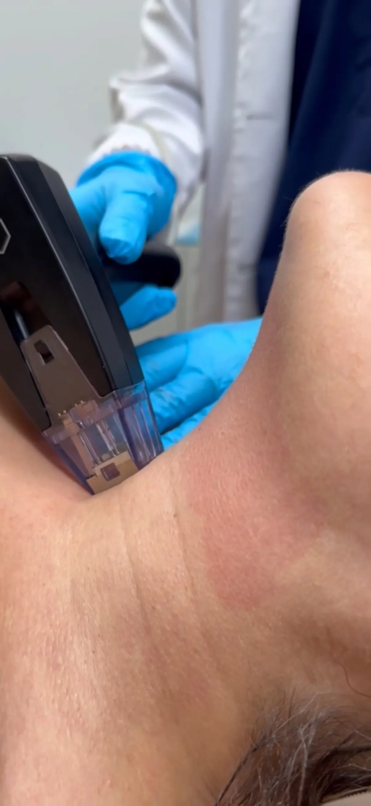 SkinPen microneedling handpiece treating the neck during a session