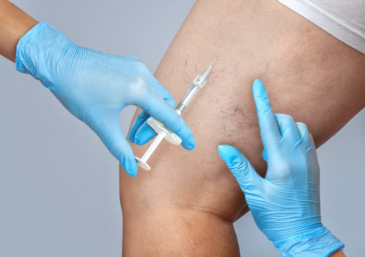 Clinician performing a fine-needle sclerotherapy injection into spider veins on a patient's leg
