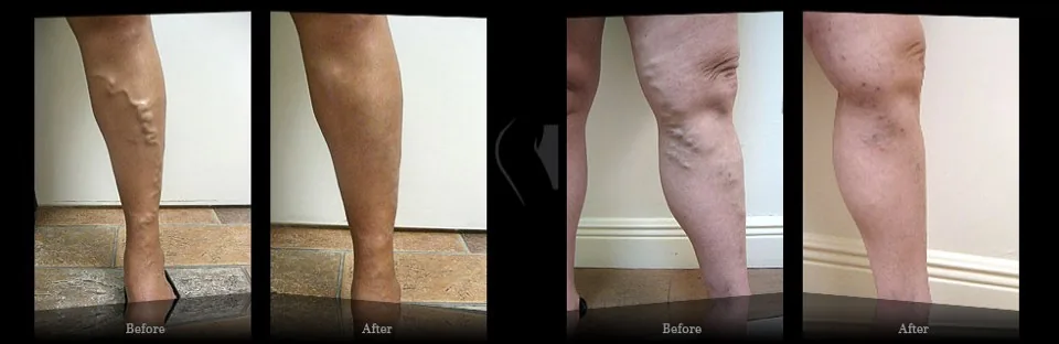 Patient legs before and after treatment showing prominent varicose veins reduced after coordinated vein care